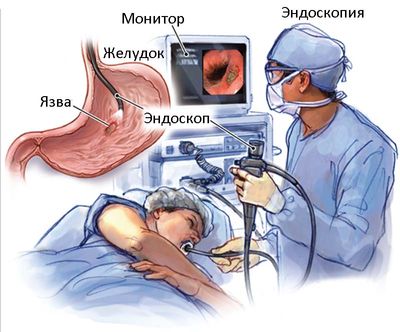 эндоскопия желудка