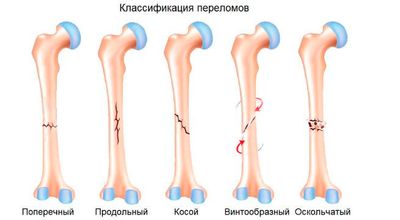 Признаки закрытого перелома костей, диагностика и лечение