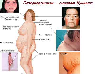 Болезнь Иценко-Кушинга