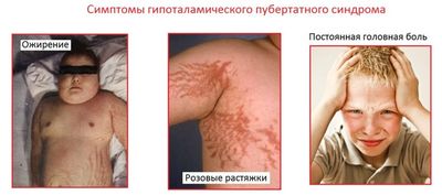 Гипофизарно-гипоталамическое ожирение