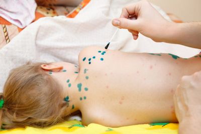 Ацикловир при ветрянке у детей и взрослых: инструкция по применению 4