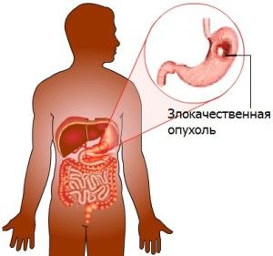 злокачественная опухоль