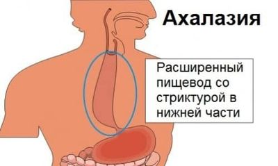 Как делают операцию при ахалазии пищевода?