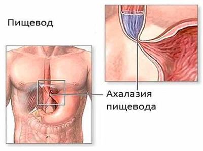 Ахалазия пищевода