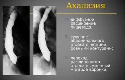 Ахалазия пищевода