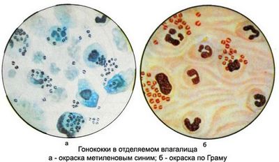 Как проводится анализ на гонорею?