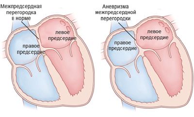 Что такое аневризма сердца и ее лечение