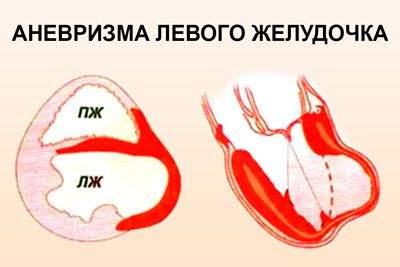 Ослабление стенки левого желудочка