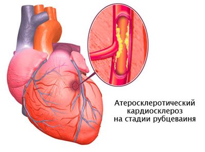 Кардиосклероз
