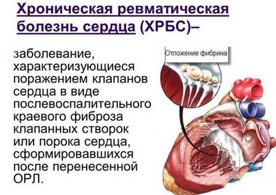 Хроническая ревматическая болезнь сердца