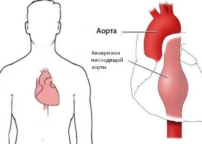 Аневризма нисходящей аорты