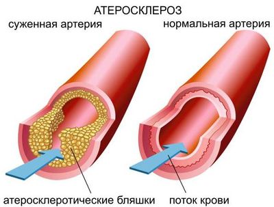 Атеросклероз