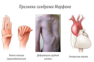 Синдром Марфана