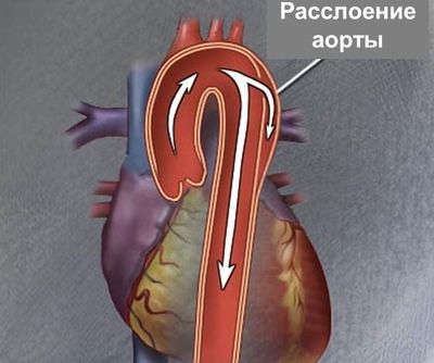 Расслоение стенки аорты