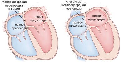 Аневризма межпредсердной перегородки (МПП)