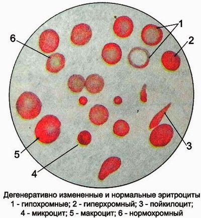 Паталогии эритроцитов