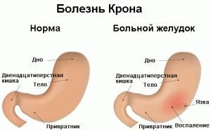 Болезнь Крона