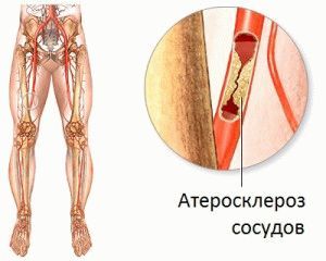 Атеросклероз нижних конечностей в старческом возрасте