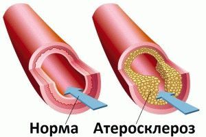 Атеросклероз ног