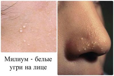 Причины появления и методы устранения белых точек под глазами