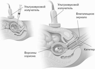 Трансцервикальный метод