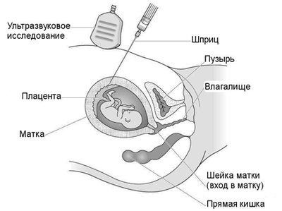 Трансабдоминальный метод