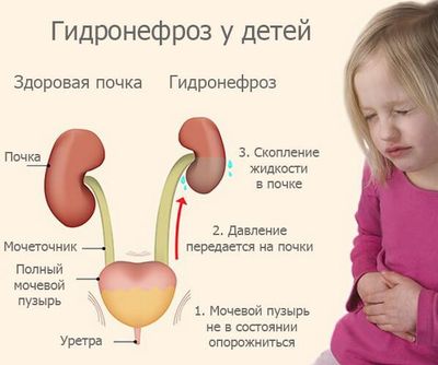 Гидронефроз