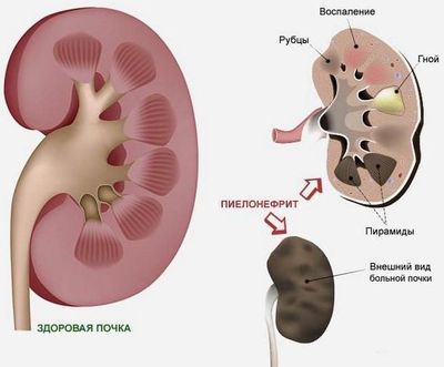 Воспаление почек ребенок