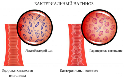симптомы бактериального вагиноза