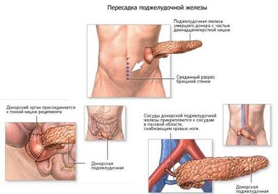 Пересадка поджелудочной железы