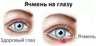 Сколько времени проходит ячмень на глазу