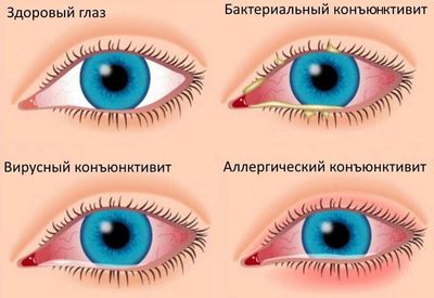 Симптомы и виды конъюнктивита