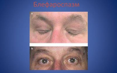 Блефароспазм