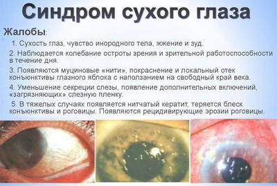 Синдром сухого глаза