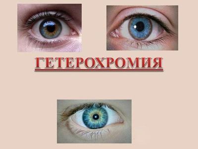 Гетерохромия глаз у человека
