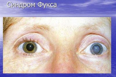 Болезнь Фукса