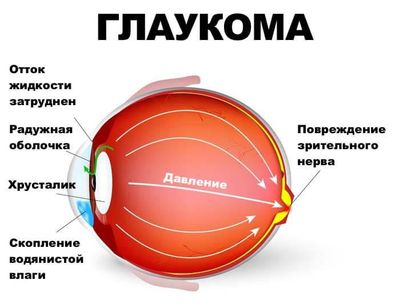 Причины, симптоматика и лечение глазного давления