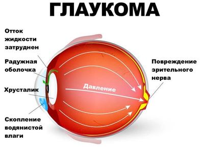 Показания к проведению лазерной иридэктомии