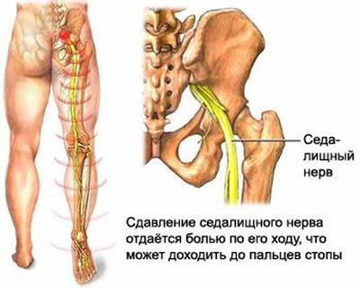 Люмбоишиалгия: симптомы, причины и лечение