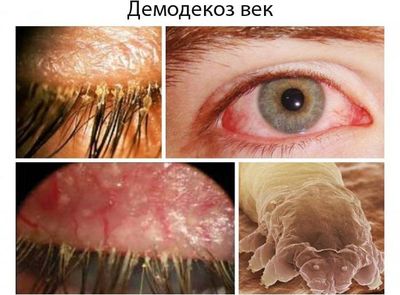 Симптомы демодекоза век
