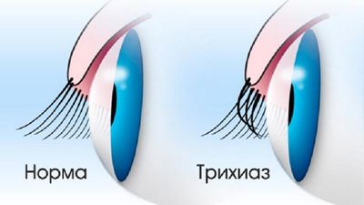 Симптомы трихиаза века