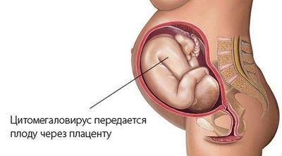цитомегаловирус у плода