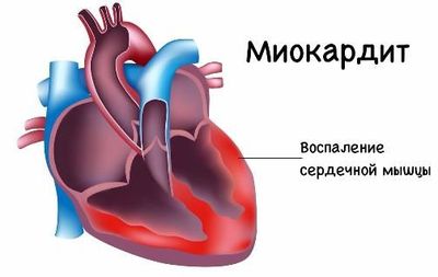 осложнения ЦМВ инфекции