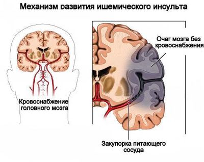 Нарушение мозгового кровообращения
