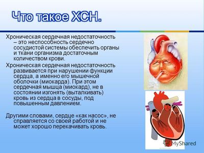 Сердечная недостаточность