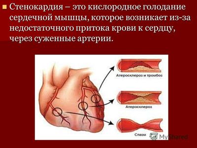 Патология сердечной мышцы