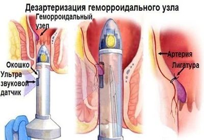 Дезартеризация геморроидальных узлов