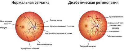 Диагностика диабетической ретинопатии