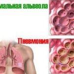 воспаление легких симптомы и лечение у взрослых