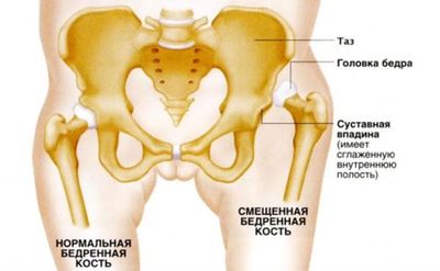 Дисплазия тазобедренных суставов у детей: как диагностируется и лечится заболевание